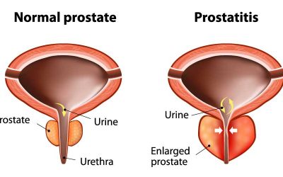 افضل طبيب لعلاج امراض الذكورة في الاردن يتكلم عن أمراض البروستاتا