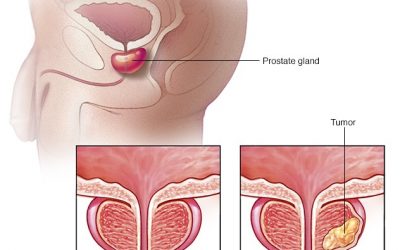 افضل طبيب لعلاج امراض الذكورة في الاردن يتكلم عن سرطان البروستات