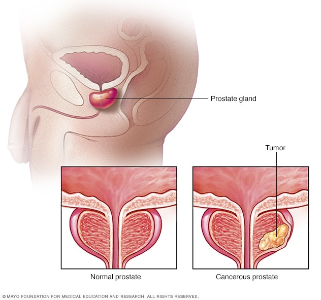 افضل طبيب لعلاج امراض الذكورة في الاردن يتكلم عن سرطان البروستات