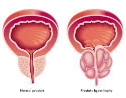 افضل طبيب لعلاج امراض الذكورة في الاردن وعلاج تليف البروستاتا